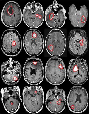 Frontiers Preoperative Brain Tumor Imaging: Models and Software for